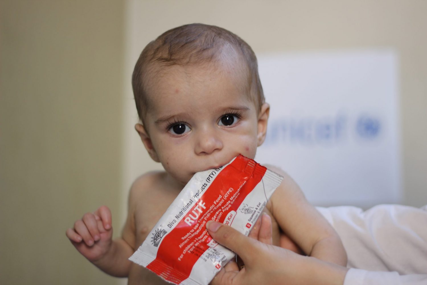 Un bebé come alimento terapéutico de UNICEF. Con tres sobres al día, durante cuatro semanas, un niño puede recuperarse de la desnutrición.